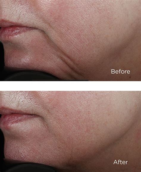 perricone md|perricone md before and after.